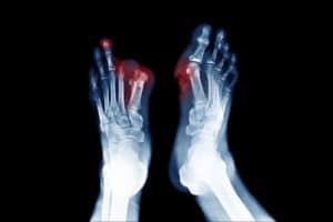 Foot pain and diabetic neuropathy, neuropathy