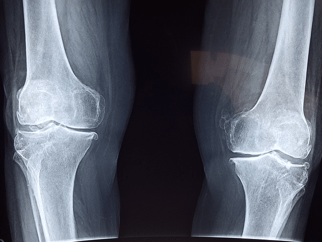 Stem cell regnerrative medicine therapy may address damaged knee cartilage
