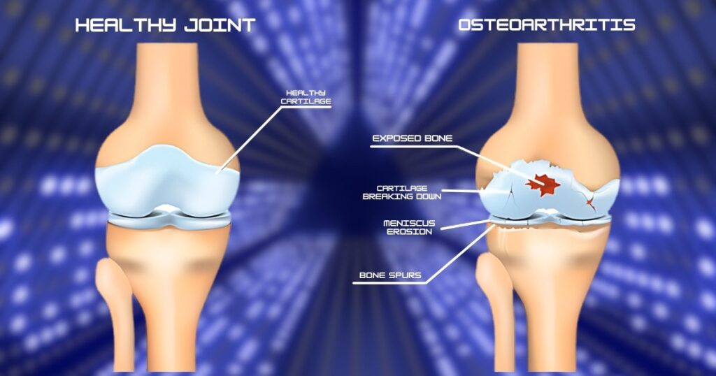 Common Form Of Arthritis, Joint Cartilage deterioration from Osteoarthritis