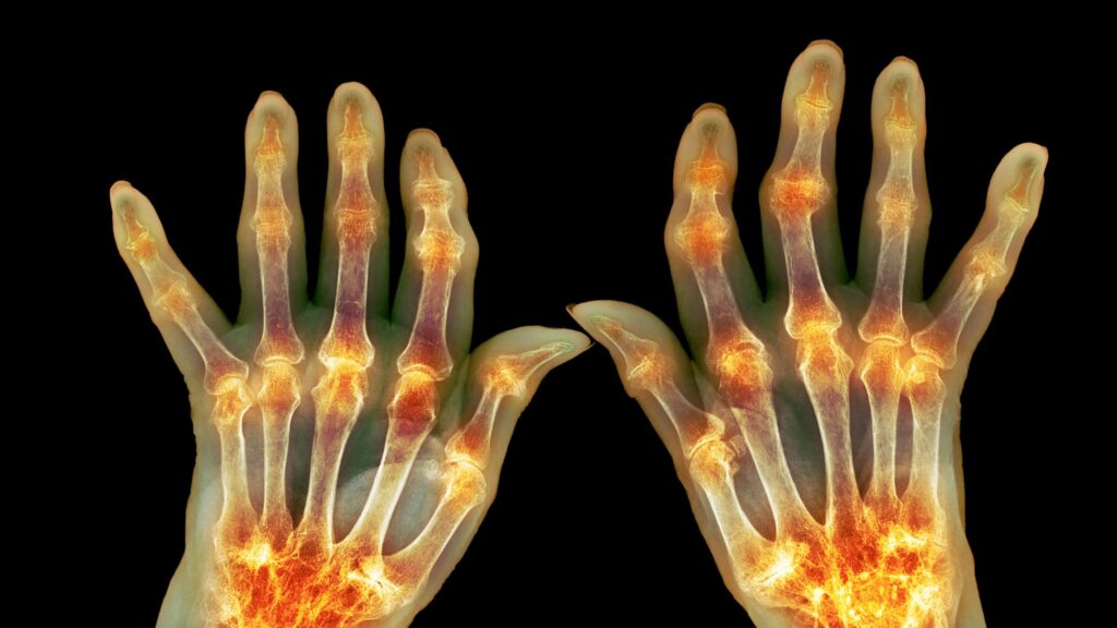 A diagram illustrating common forms of arthritis, including rheumatoid arthritis and osteoarthritis.